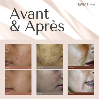 Micro-Aiguillage Visage